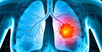 ആശങ്കയുണർത്തി പുകവലിക്കാത്തവരിലെ ശ്വാസകോശാർബുദം വർദ്ധിക്കുന്നു OIP 3 2 Health